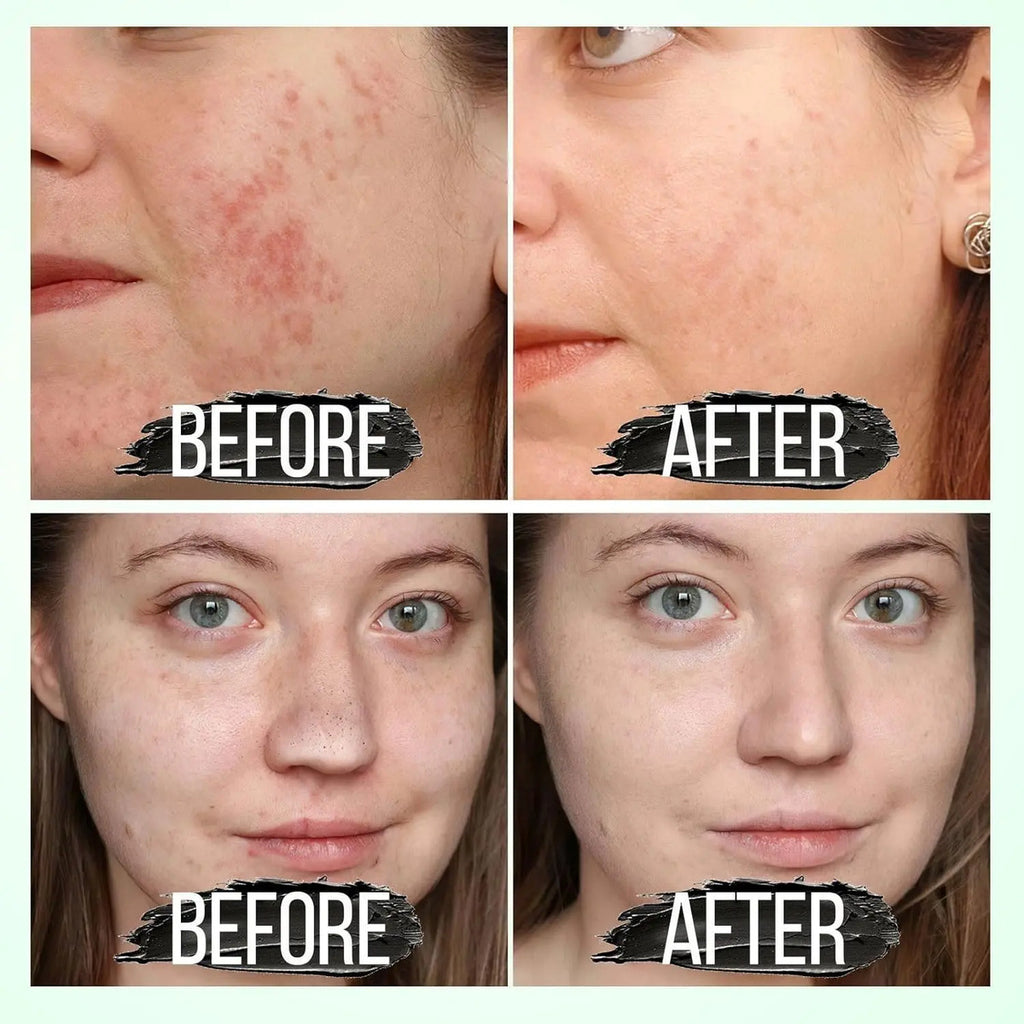 Mascarilla Facial Flower Secret - Limpieza Profunda de Puntos Negros y Acné